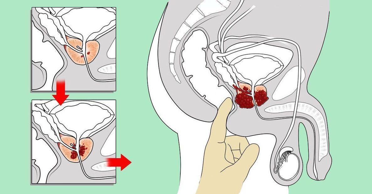 comment masser la prostate